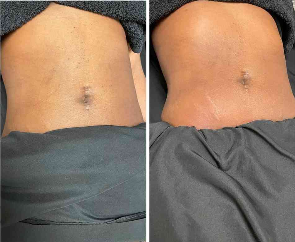 A person’s tummy after a laser lipo treatment
