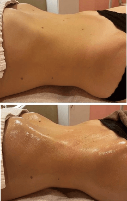 Two pictures of a woman getting a massage before and after.