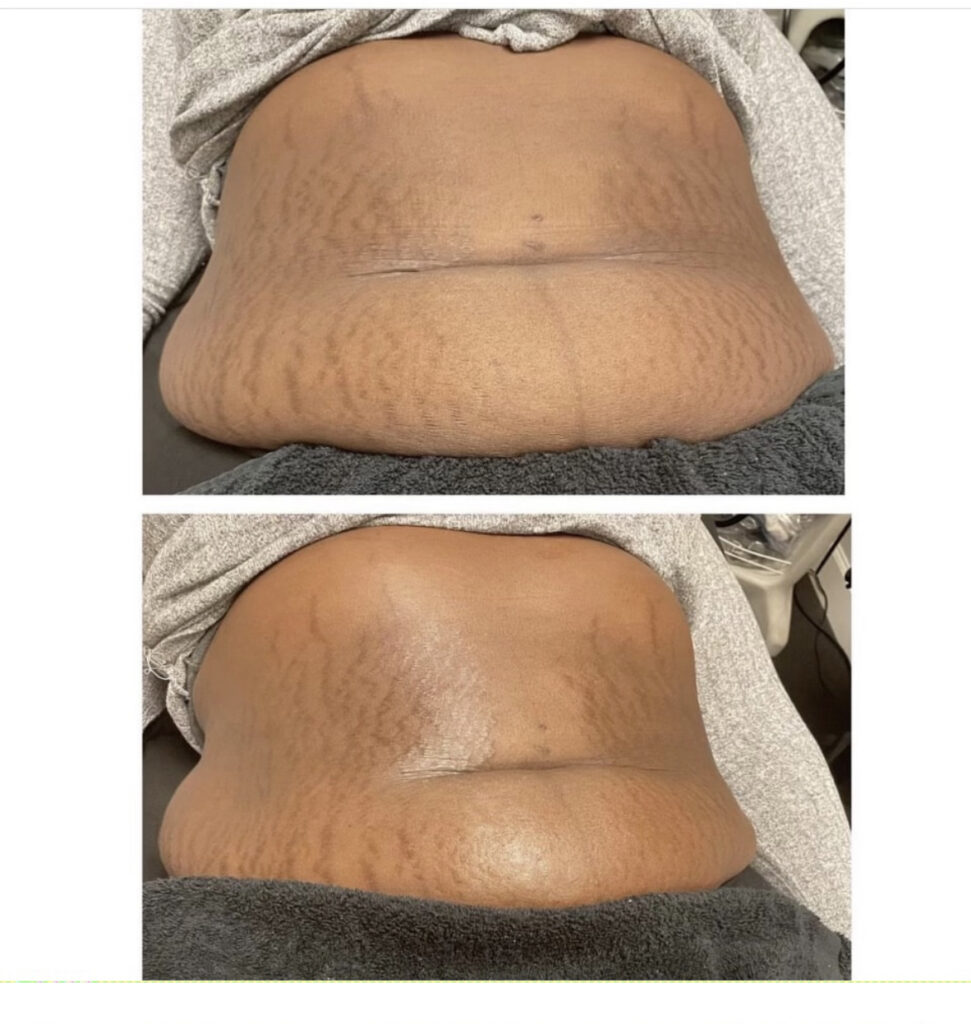 Before and after massage image of a belly
