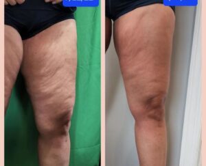 A woman with cellulite and no visible vein.
